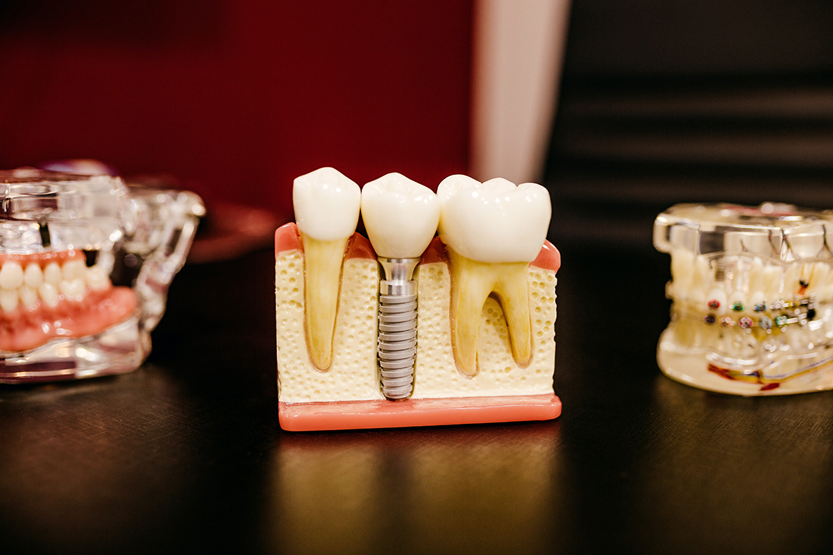 Find Dental Implants in Karve Road Kothrud at Nova Dental Care