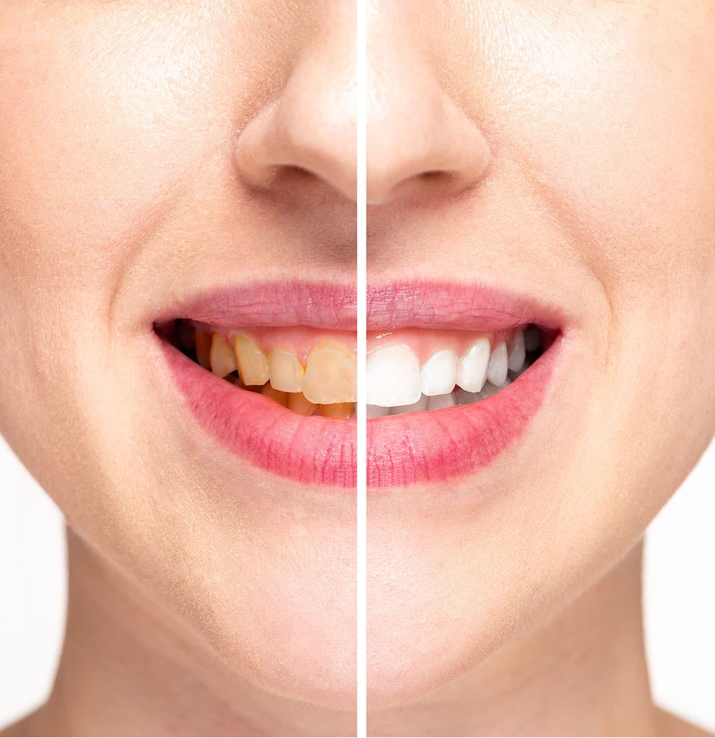 Smile Makeover Treatment in Karve Road Kothrud