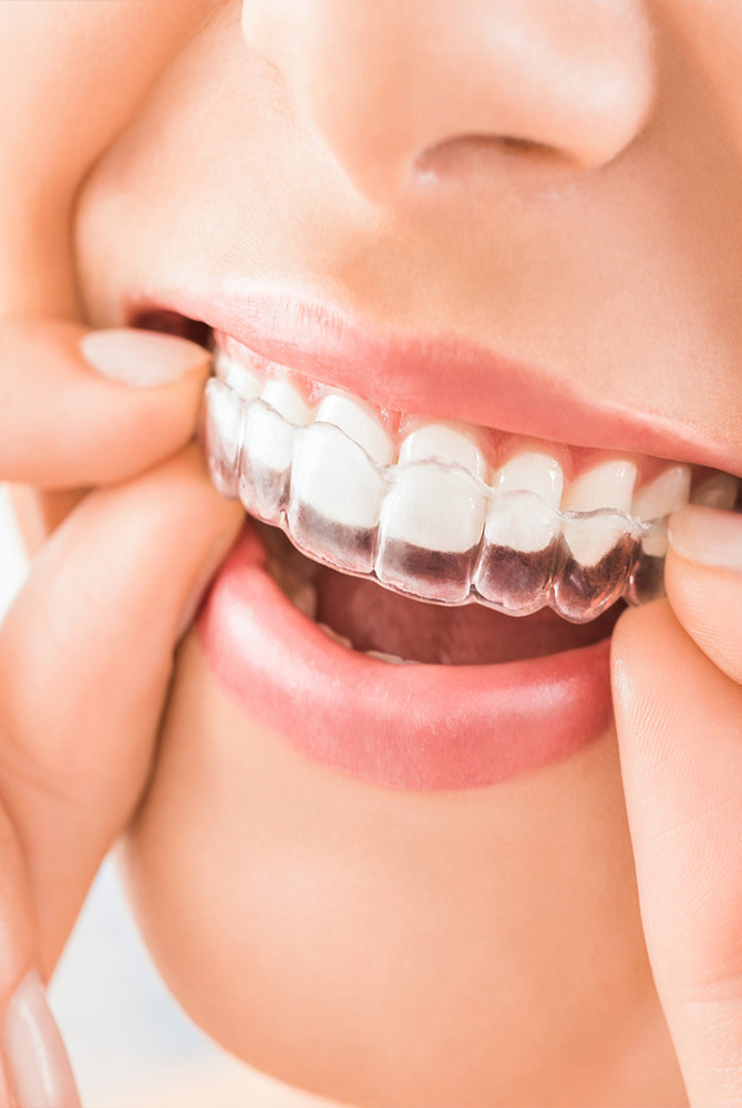 Invisalign Treatment in Karve Road Kothrud Pune