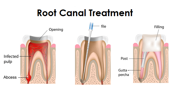 Best Root Canal Treatment in Kothrud