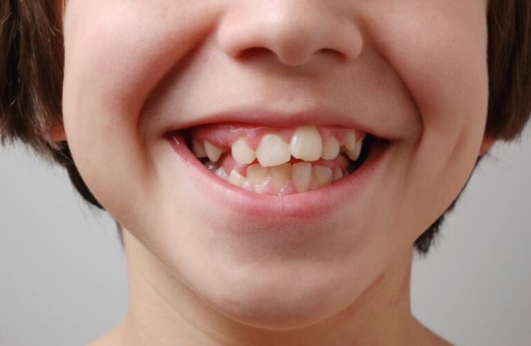 Recognizing When Your Child Needs Orthodontics