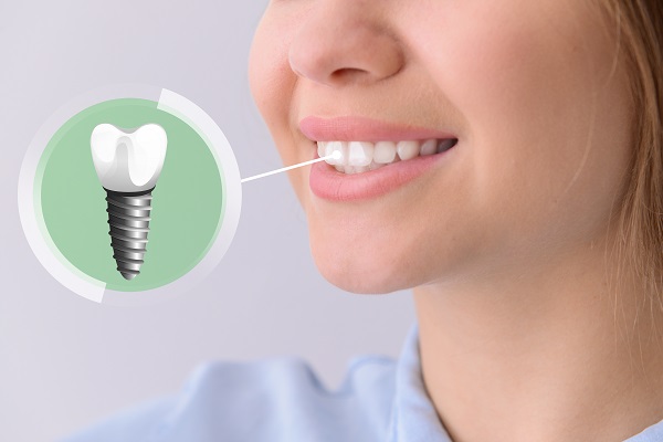 Want to Know Benefits of Dental Implants? - Novacare Dental