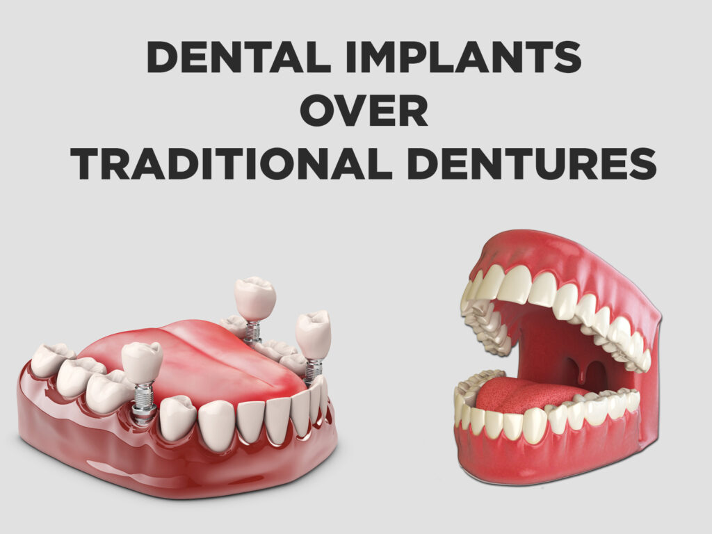 Benefits of Dental Implants Over Traditional Dentures